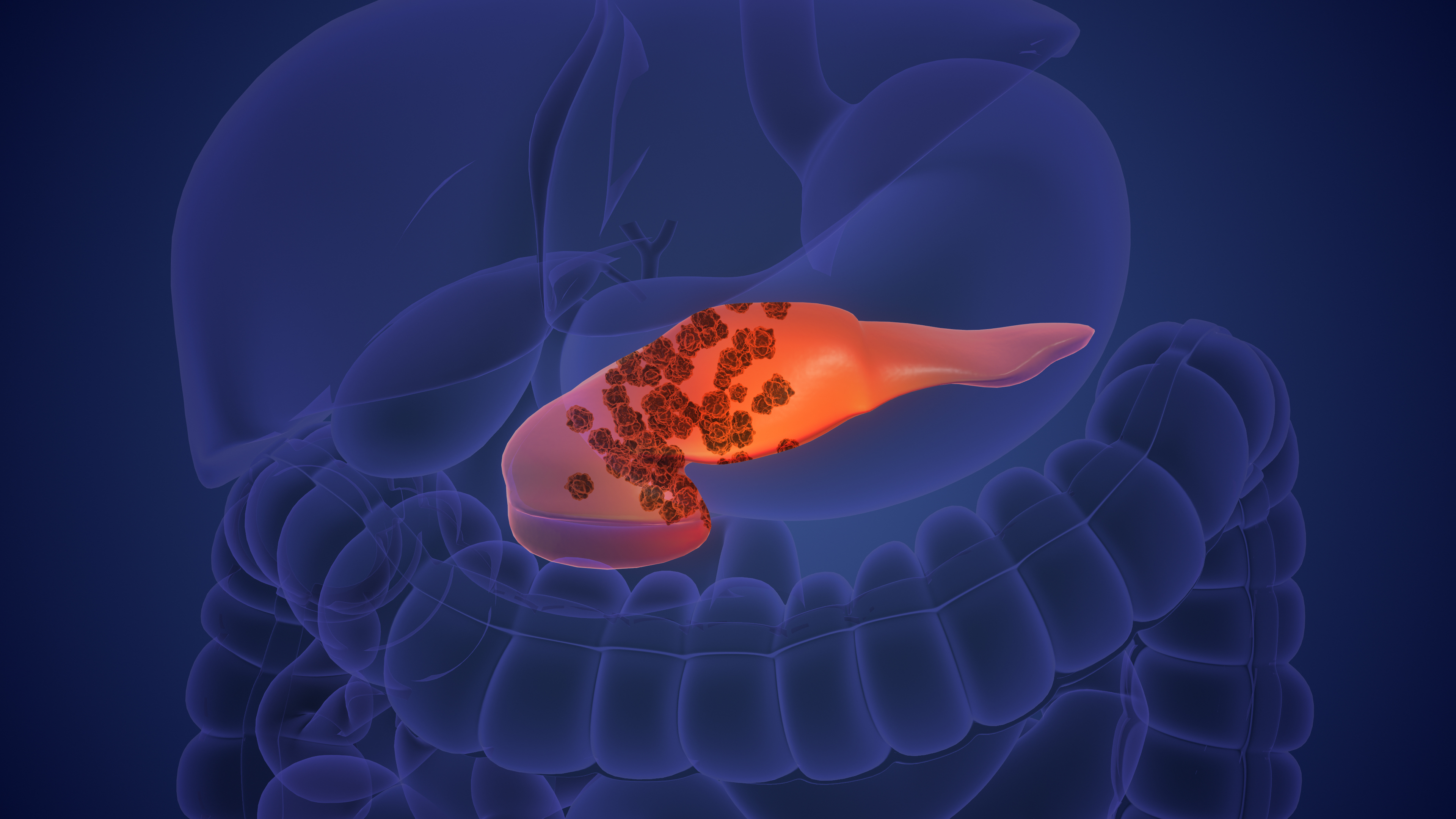AI prevede tumore al pancreas AI prevede tumore al pancreas
